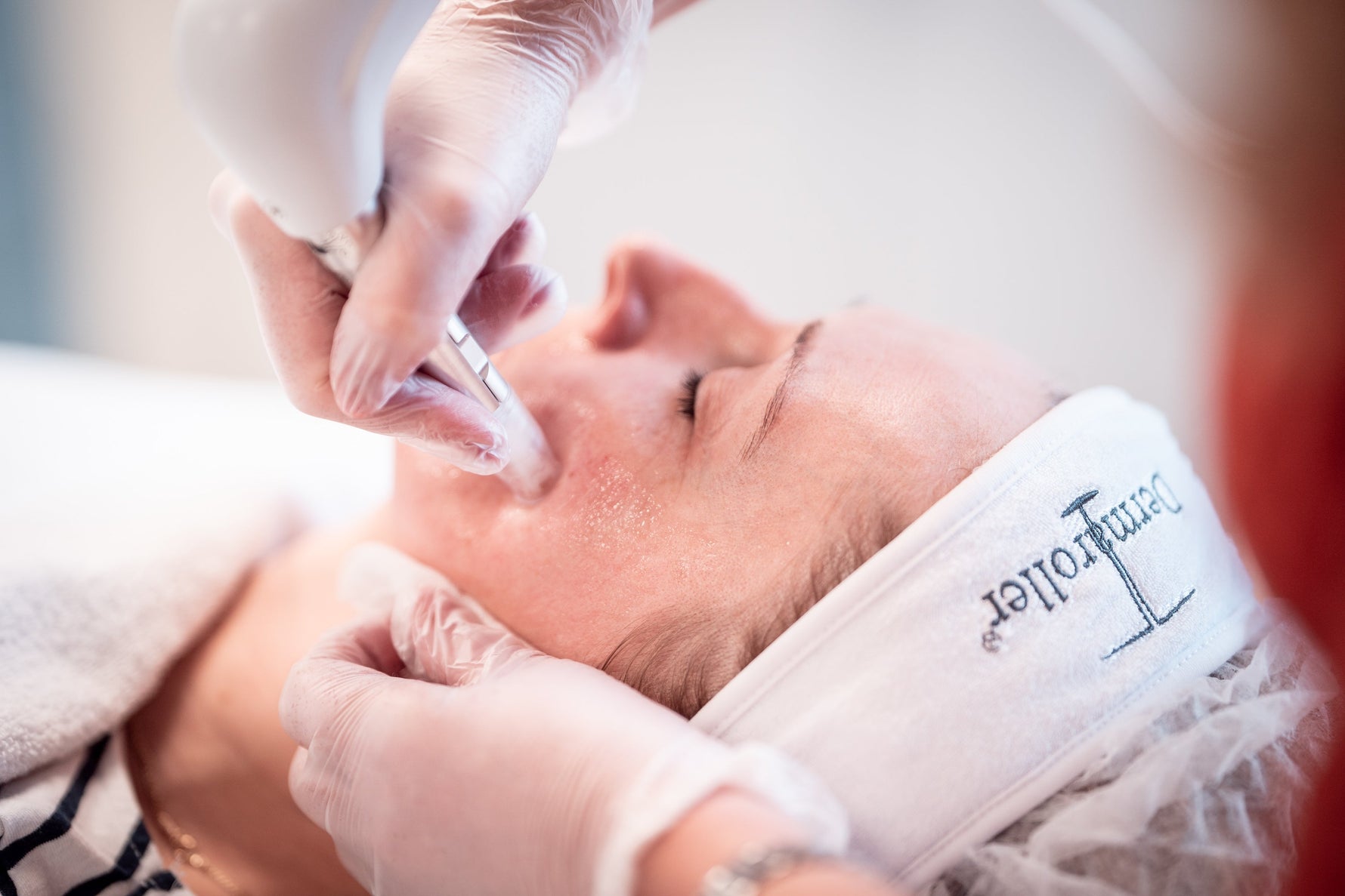 Microneedling behandling – fordeler, prosess og resultater